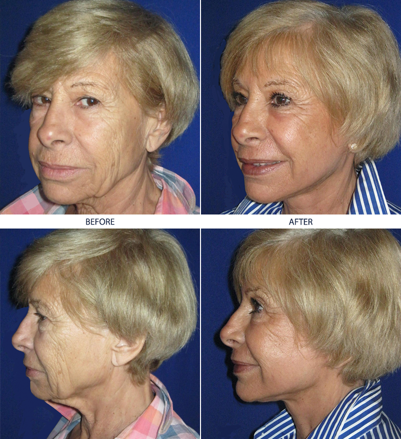Facelift-Before-After